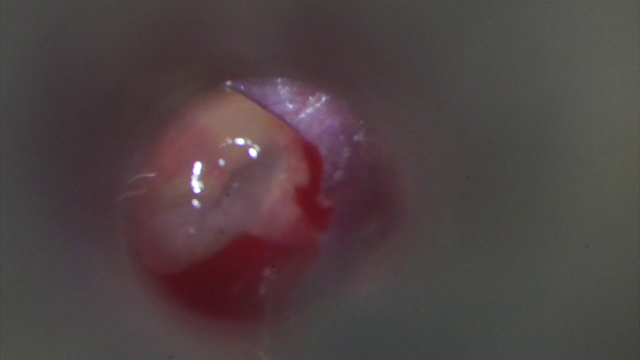 Trommelfellschnitt und Paukendrainage