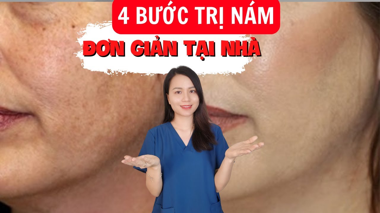 Nám da mặt và cách chữa trị 4 bước đơn giản ngay tại nhà | Nguyễn Mai Hương
