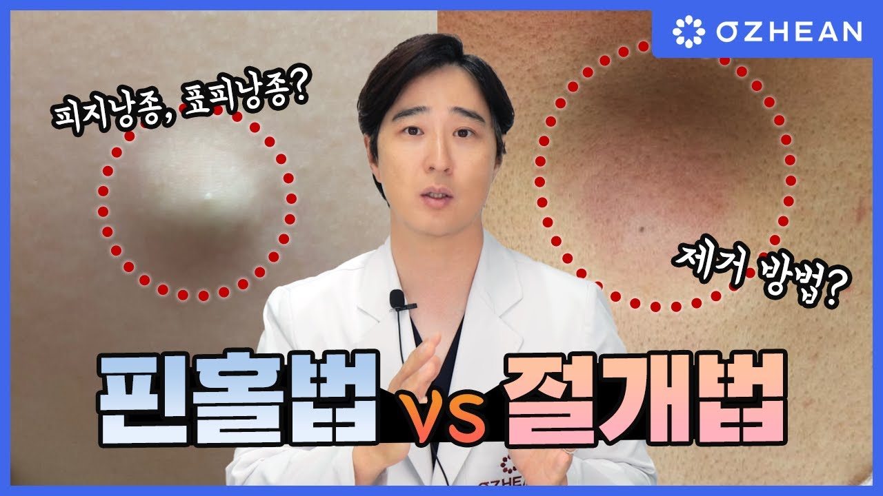 핀홀법 vs 절개법: 당신에게 맞는 피지낭종, 표피낭종 제거 방법은?