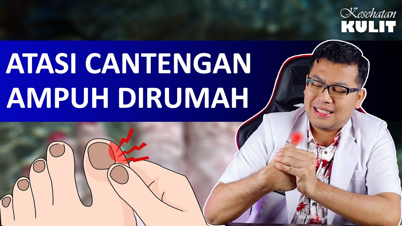 TIPS AMPUH MENGOBATI CANTENGAN - DOKTER SADDAM ISMAIL