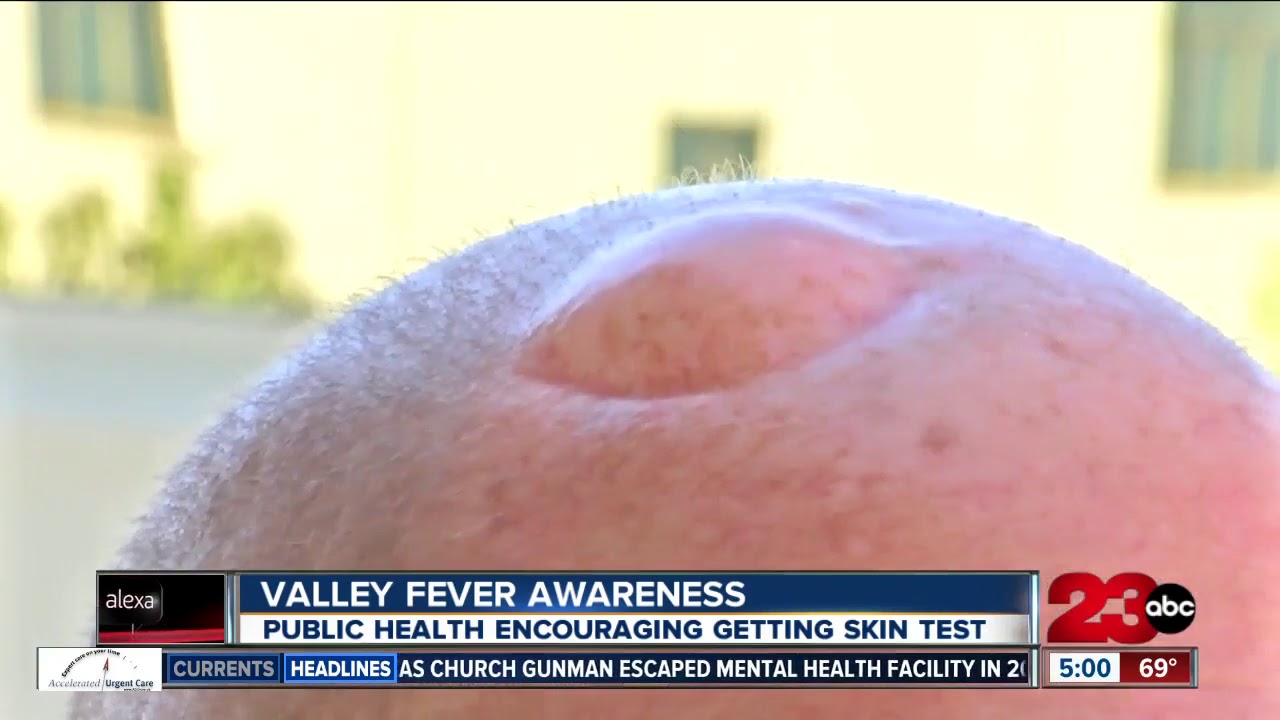 Sheriff Youngblood shares personal valley fever experience