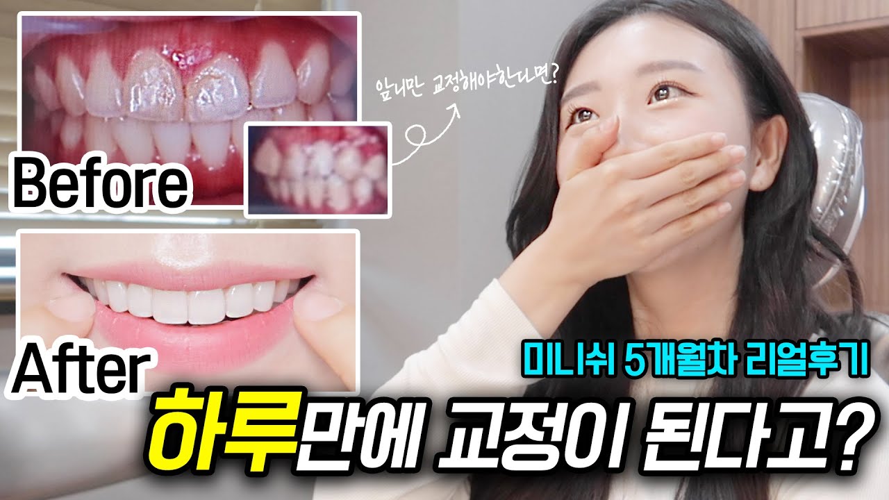 하루만에 교정이 된다고? 미니쉬 5개월차 리얼후기 | 치아미백,잇몸성형, 금니교체