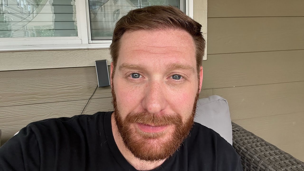 Month 6 Post Hair Transplant Cosmedica Turkey & TRT effects. 