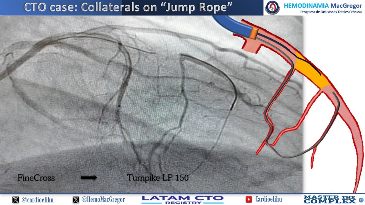 Collaterals on jump rope