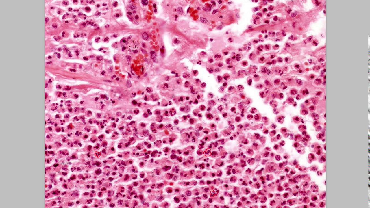 Histology- Acute vs Chronic Inflammation
