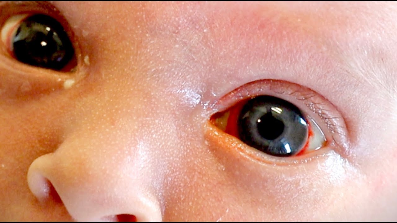 HELP! My Newborn Has Blood in the White of His Eyes (Subconjunctival Hemorrhage)