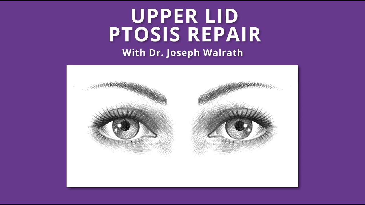 Upper Lid Ptosis Repair