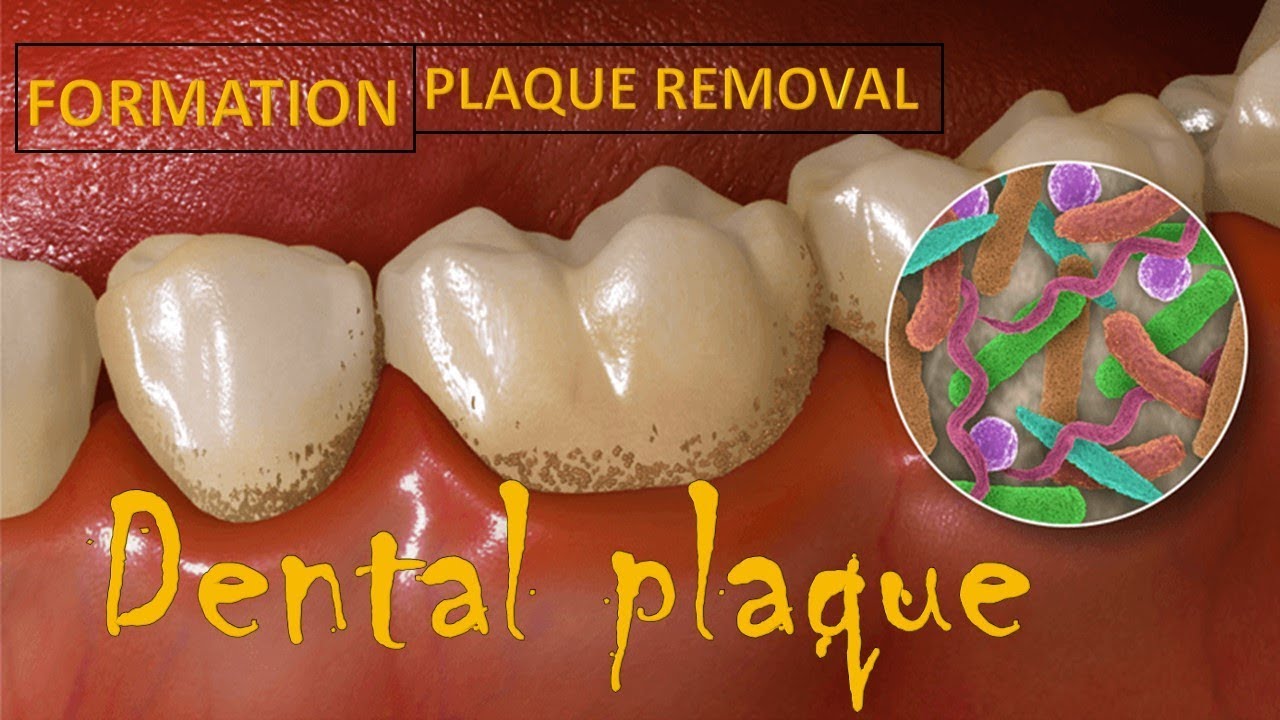 Dental Plaque