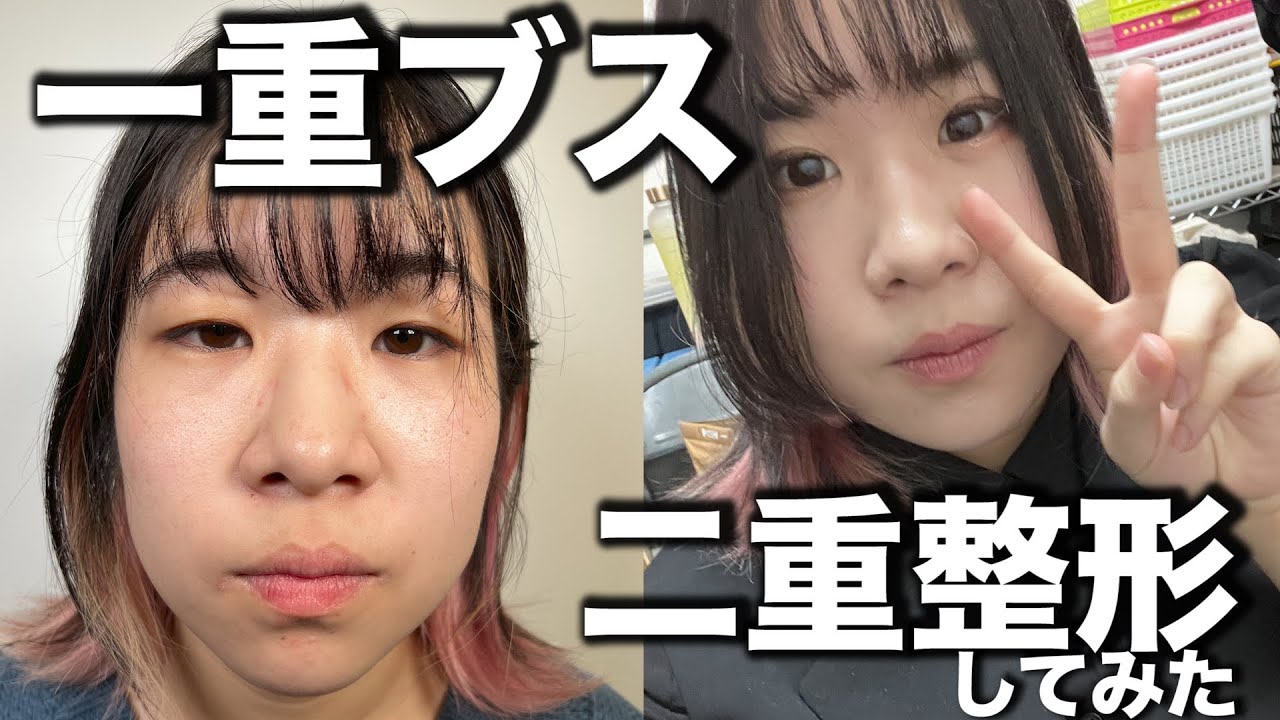 【二重整形】24年間悩んだから埋没やっとしてみた