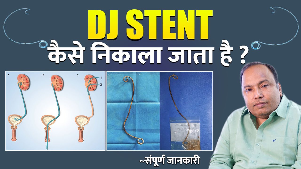 Dj Stent Removal - क्या स्टेंट निकलवाना Painful प्रक्रिया है ? | Is DJ stent Removal Painful ?