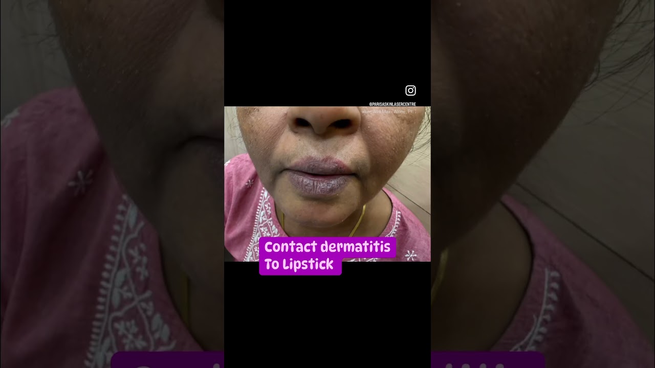 Lip stick Dermatitis | lip eczema | lipcare | Dermatologist in Punjab | Dr Ashima Goel