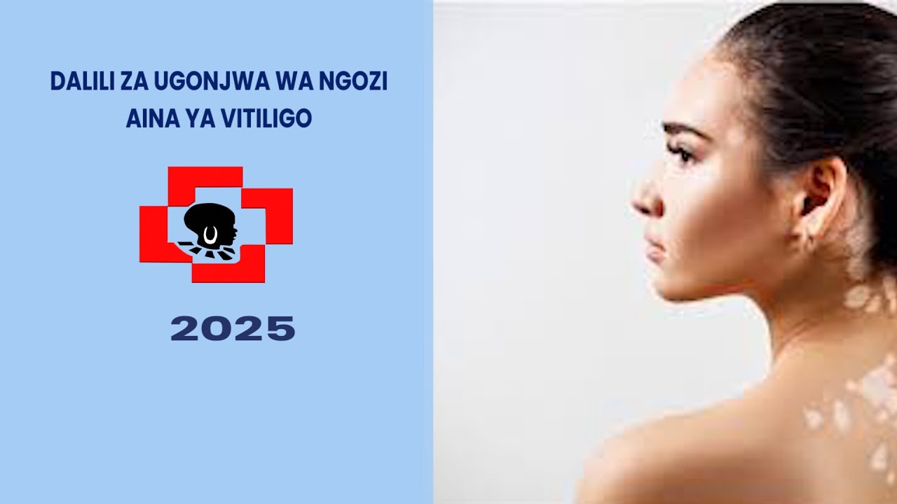 ZIFAHAMU DALILI ZA VITILIGO KWA MWANADAMU