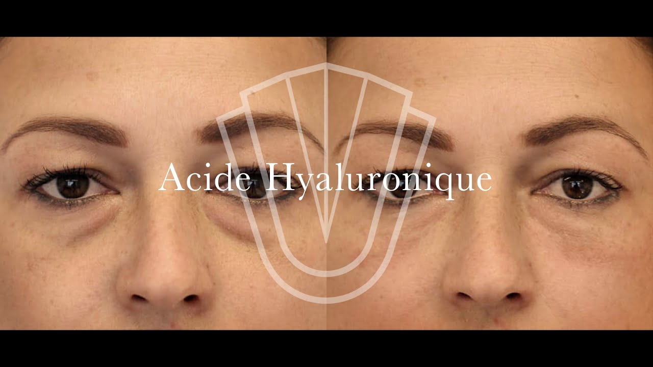 Acide Hyaluronique - Cernes