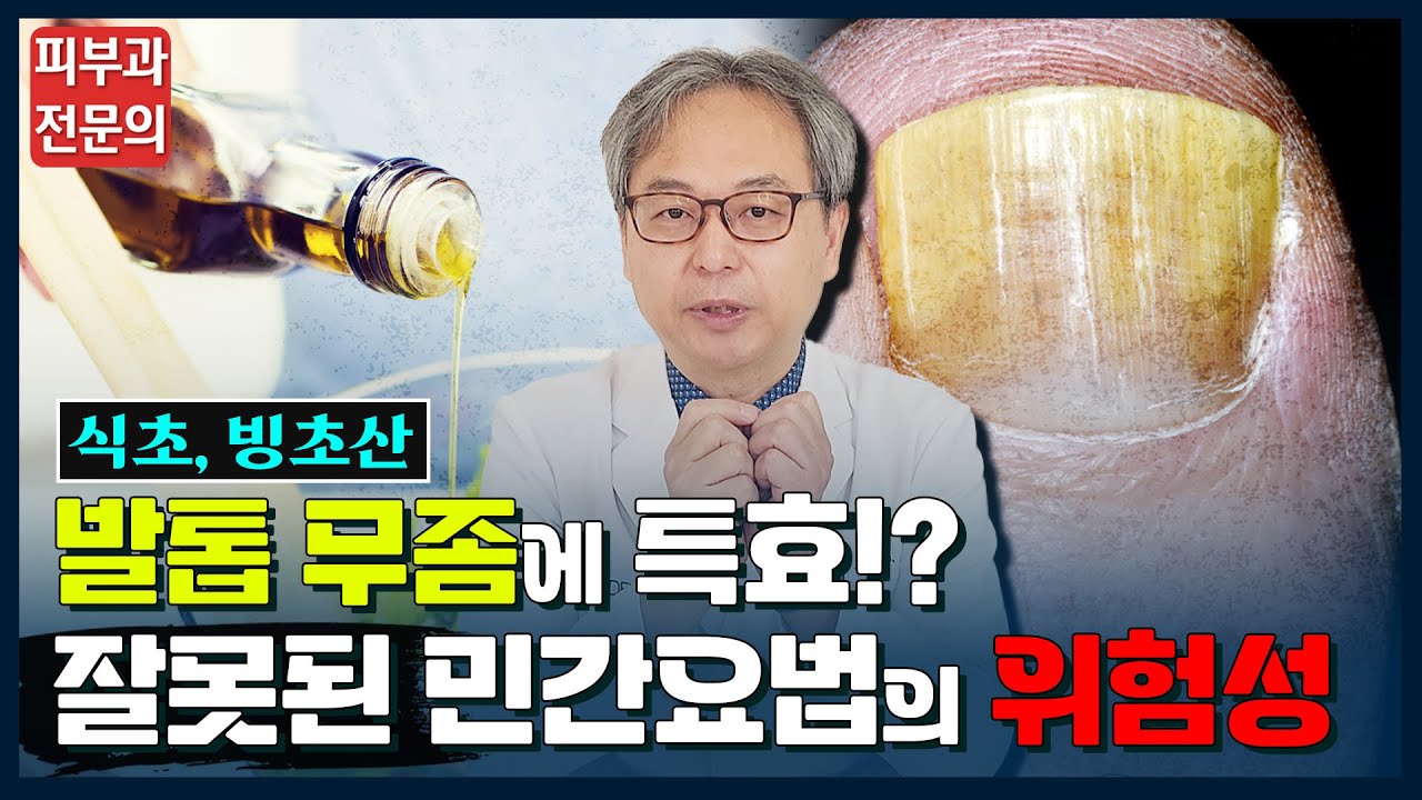 발톱무좀 민간요법 정말로 효과가 있을까요? #발톱무좀 #무좀 #손발톱무좀