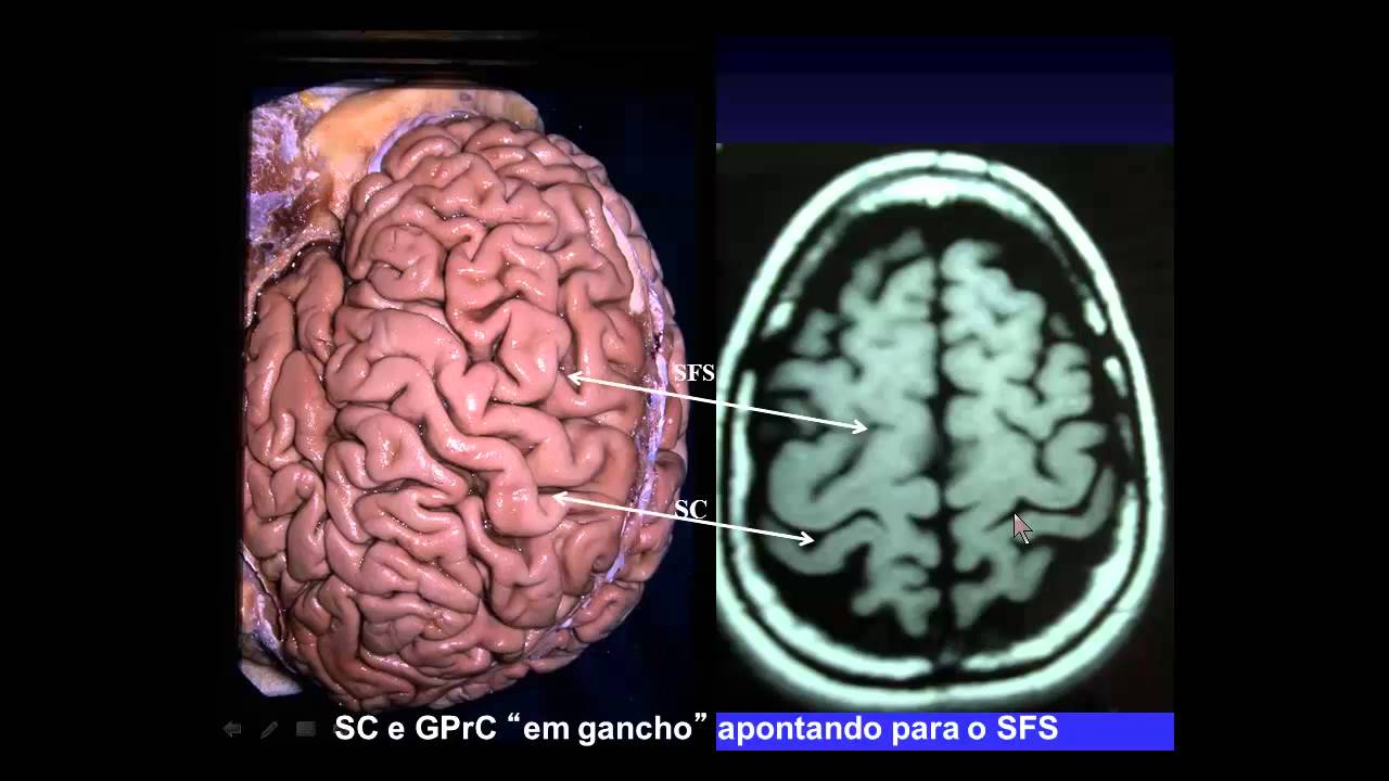 Sulcos e Giros na TC e RNM