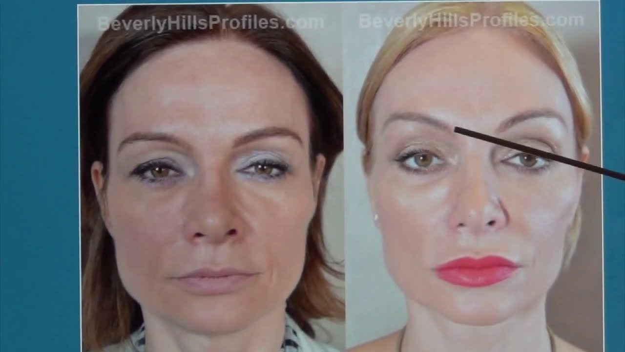 Patient with dropping brows | Brow lift at Beverly Hills Profiles