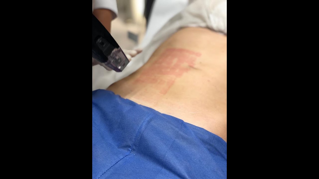 MORPHEUS 8. Aplicación corporal en abdomen.