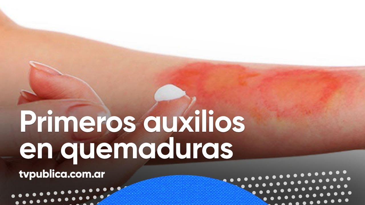 Tratamiento para las quemaduras - Mañanas Públicas