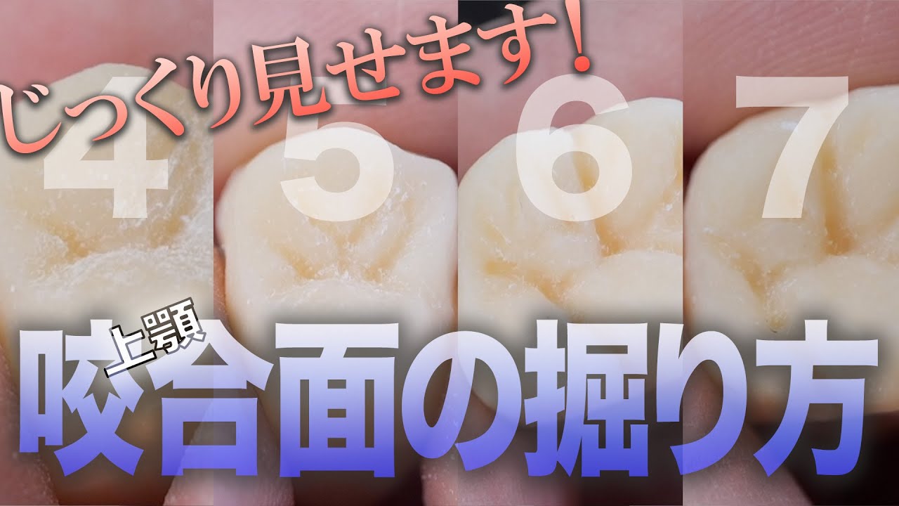 【衛生士さん向け】じっくり見せます！上顎咬合面の溝の掘り方