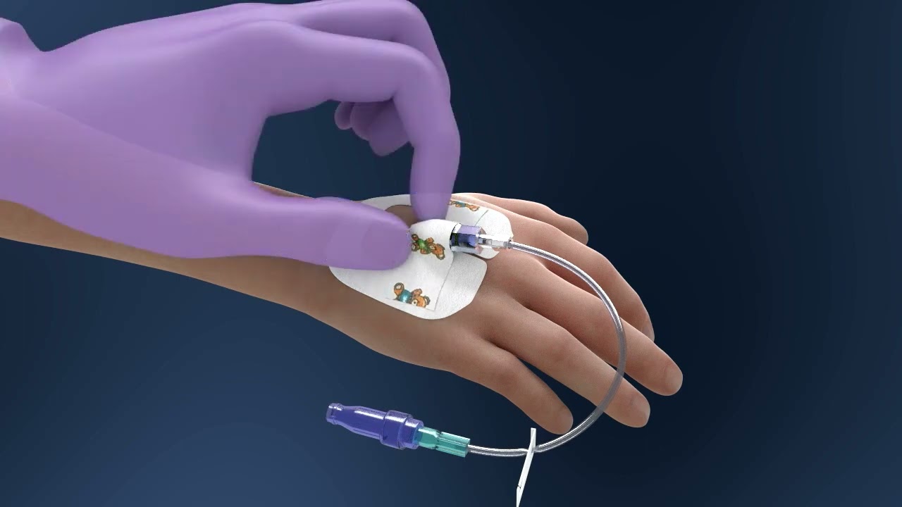 Katheterfixierung bei Kindern mit 3M&trade; Tegaderm&trade; I.V. Advanced
