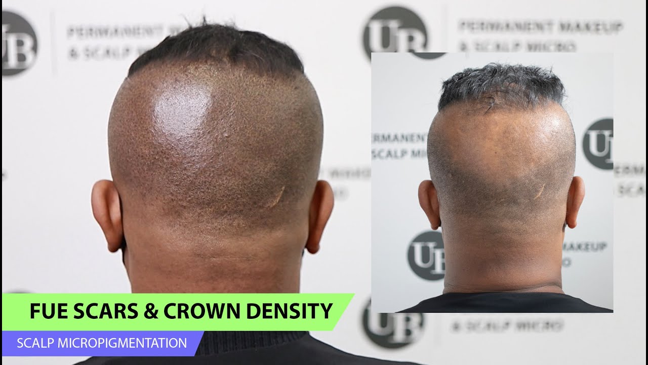 Camouflaging FUE Scars After Hair Transplant at Unyozi Beauty