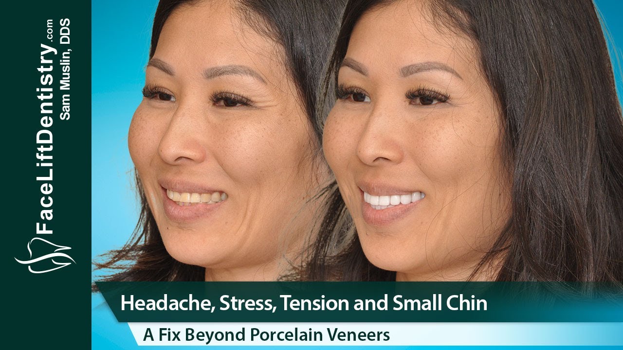 Worn Down Teeth, Aging Face, Sinking Jawline, 8-Day Fix
