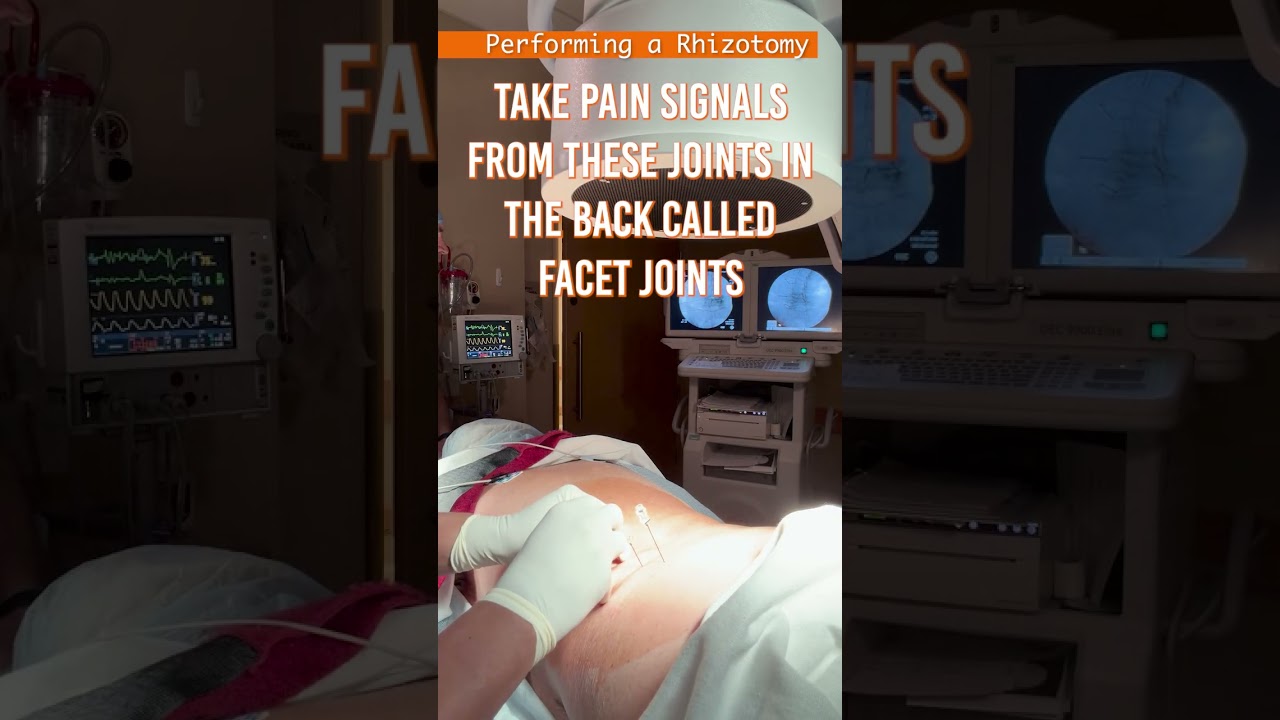 Radiofrequency Ablation / Rhizotomy for Low Back Arthritis | Video of actual procedure