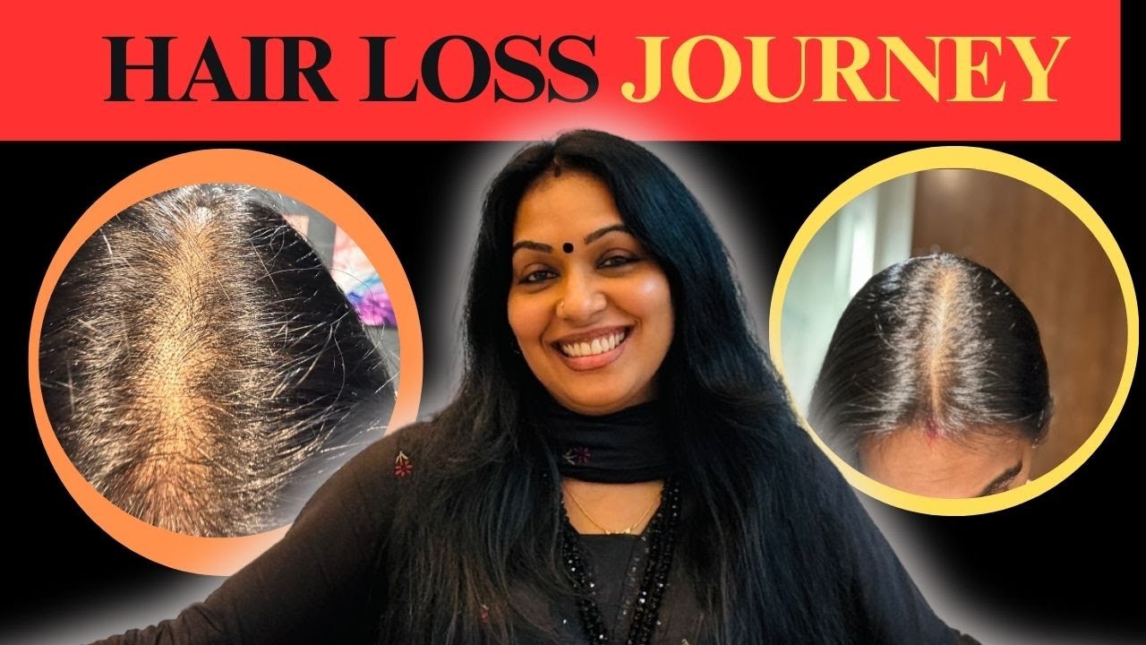 My Hair Loss Journey | എന്റെ മുടി കൊഴിച്ചിൽ എങ്ങനെ കുറച്ചു ? | മാനസിക വേദനയും ഡിപ്രെഷനും|   Part 1