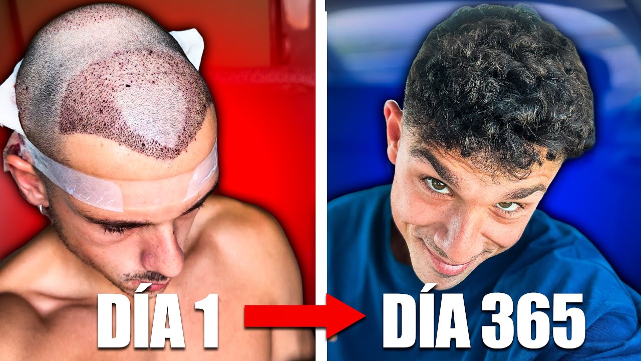 Un año después del trasplante capilar: esto es lo que nadie te cuenta