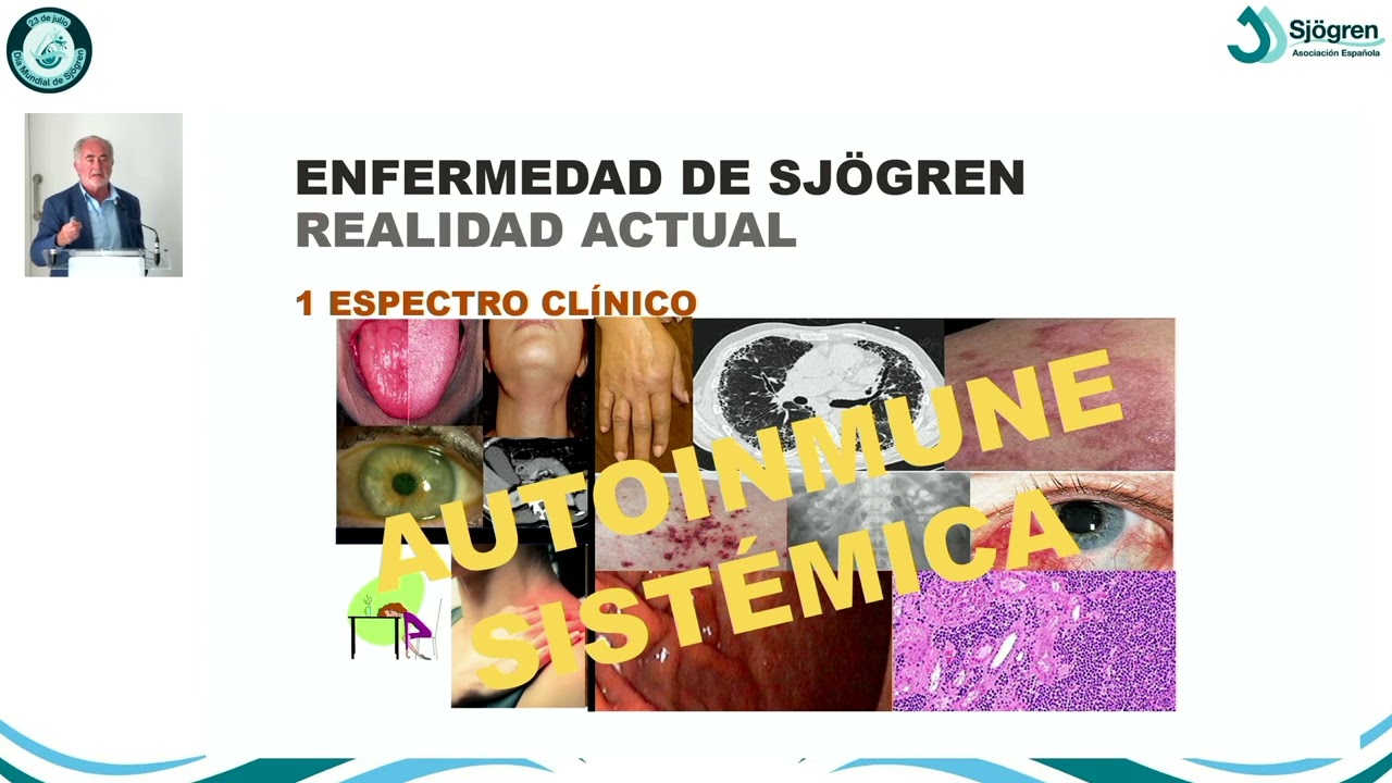 Sjögren: Retos y perspectivas médicas y emocionales