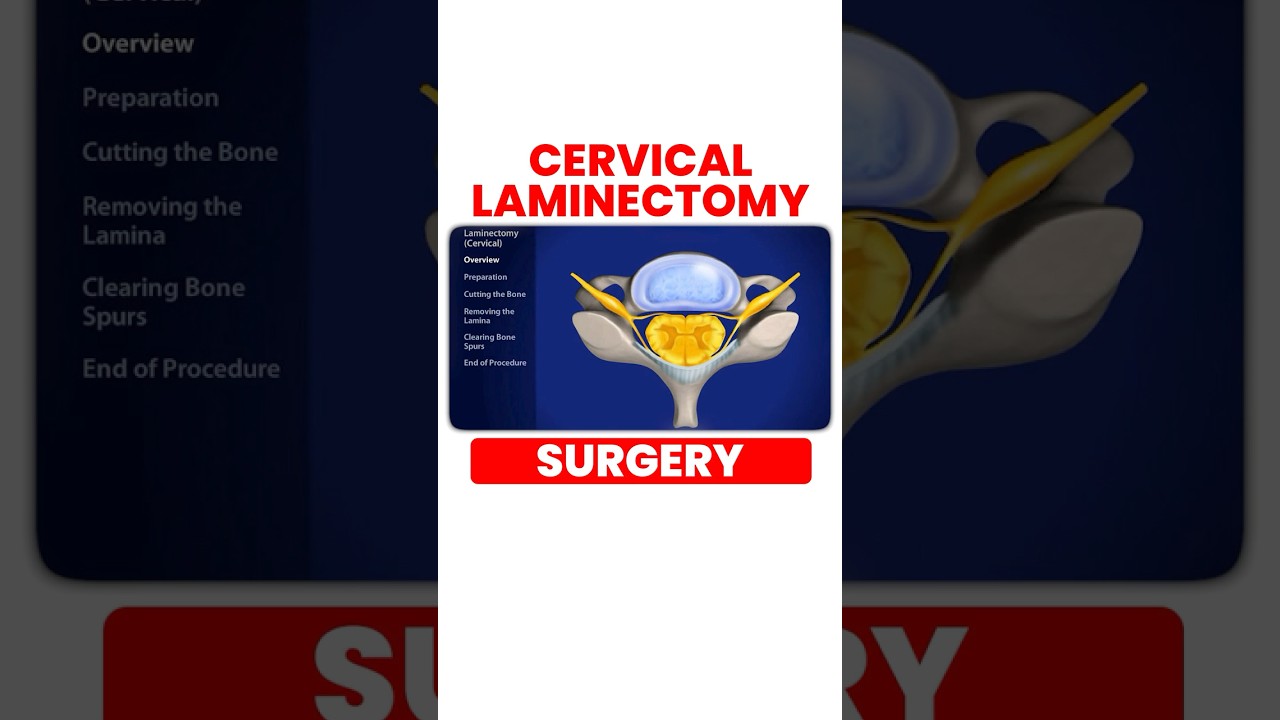 Cervical Laminectomy Surgery #shorts