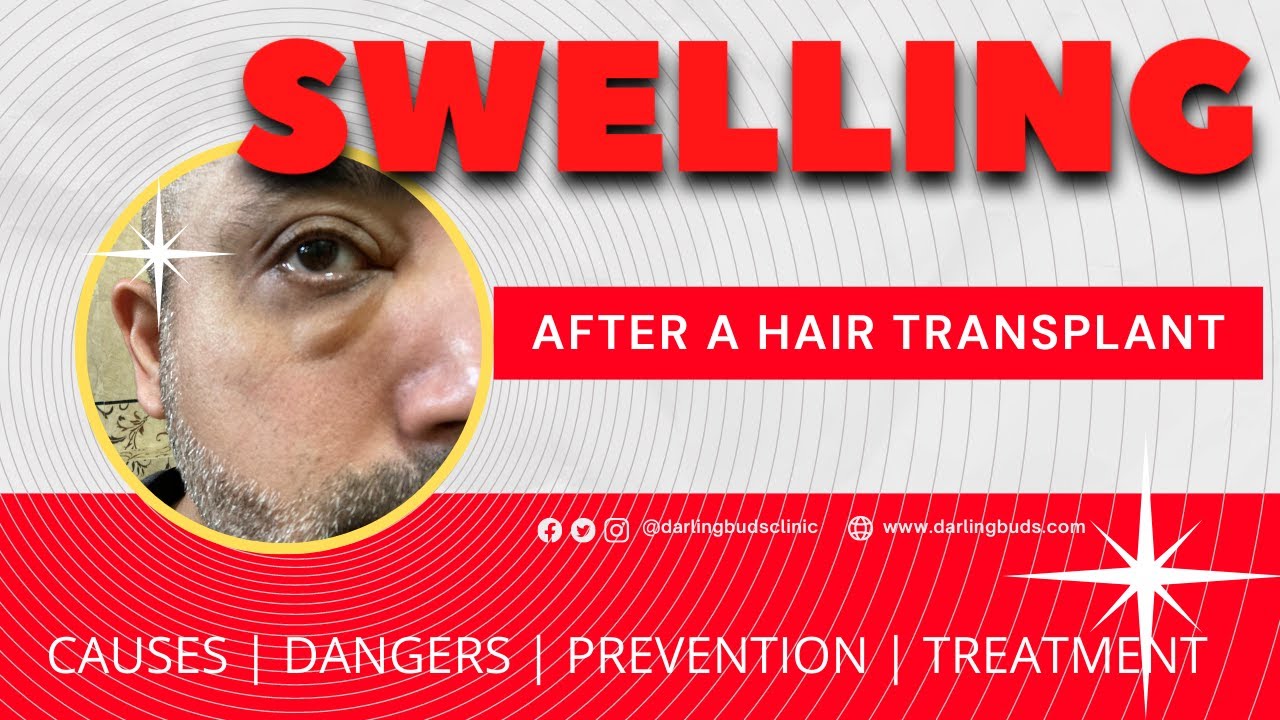How to prevent swelling after hair transplant | My Comprehensive Guide