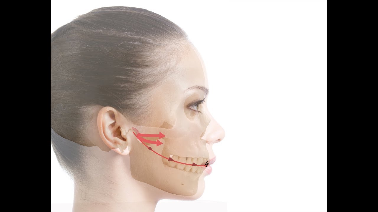 Solutions To Worn Teeth - Functional Smile Design