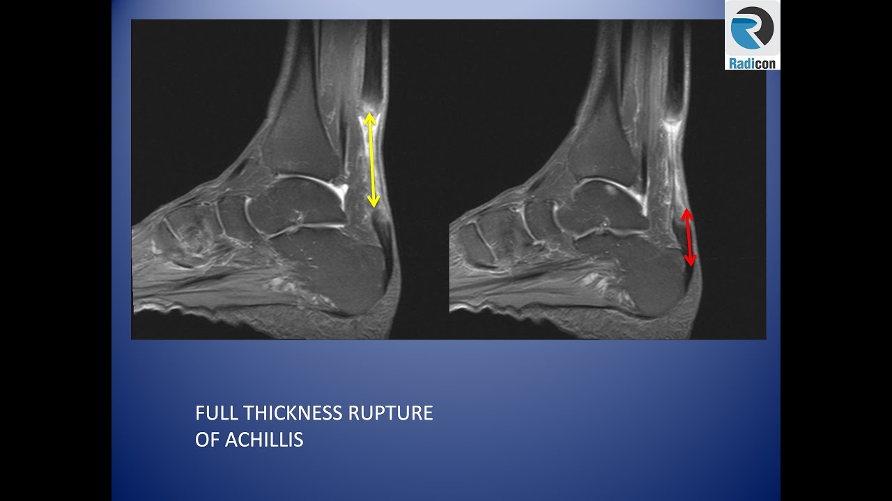 Ankle MRI Part 4: Achilles and Plantar Fascia