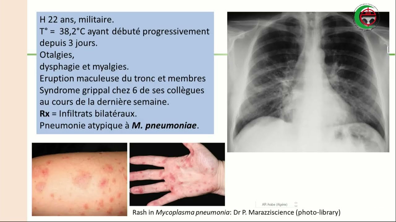 Pr MOHAMED ZEROUAL : Pneumopathies bactériennes aigues