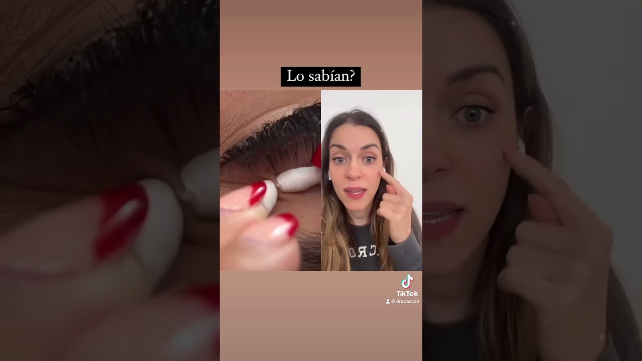 Quistes de millium, video completo en mi canal #quistesdemillium
