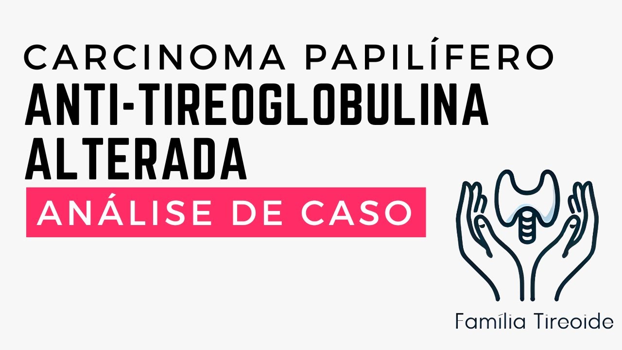 Anti-tireoglobulina alterada no seguimento do câncer - Analisando exames