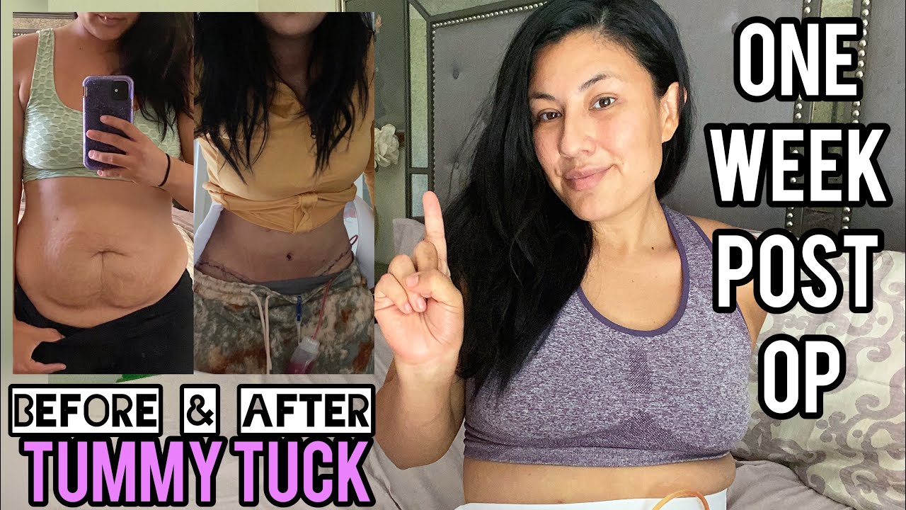 ONE WEEK POST OP UPDATE | TUMMY TUCK WITH DOC TANEJA EP. 4 | Alma Rivera Beauty