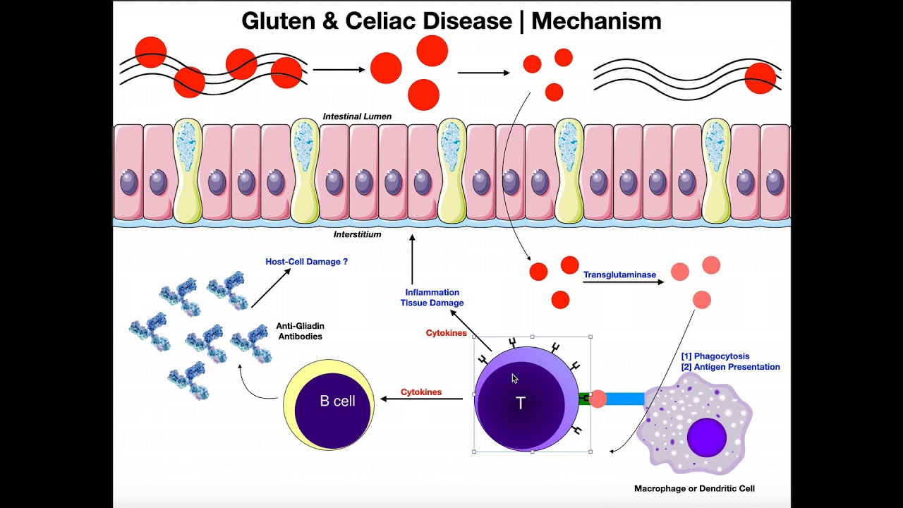 GLUTEN! Mechanisms of Celiac Disease and Gluten Sensitivity