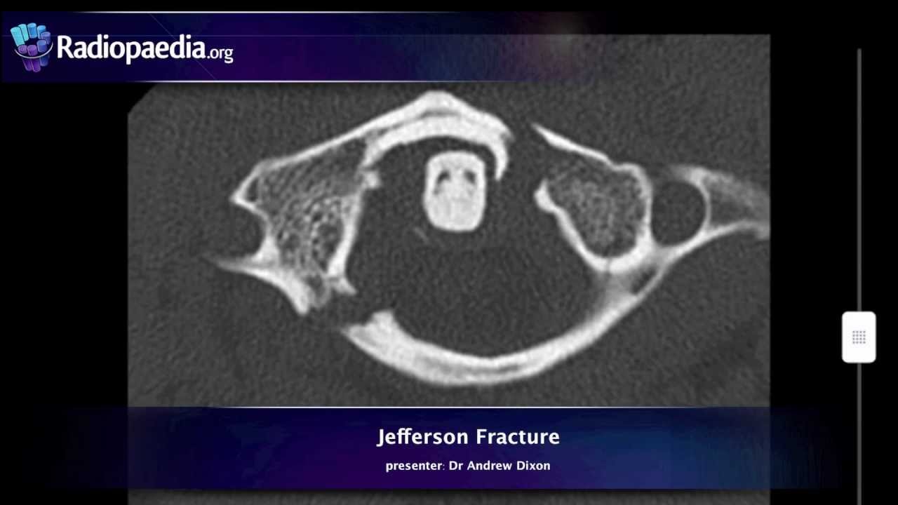 Jefferson fracture - radiology video tutorial (x-ray, CT)