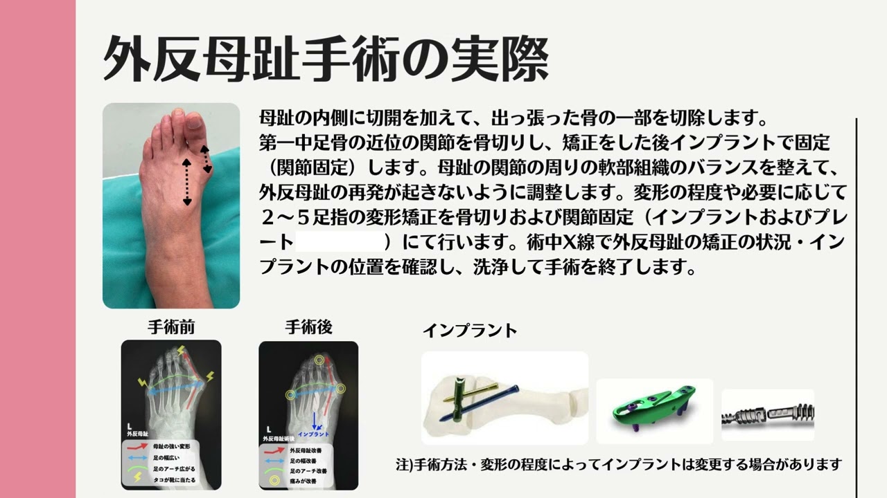 外反母趾手術説明動画