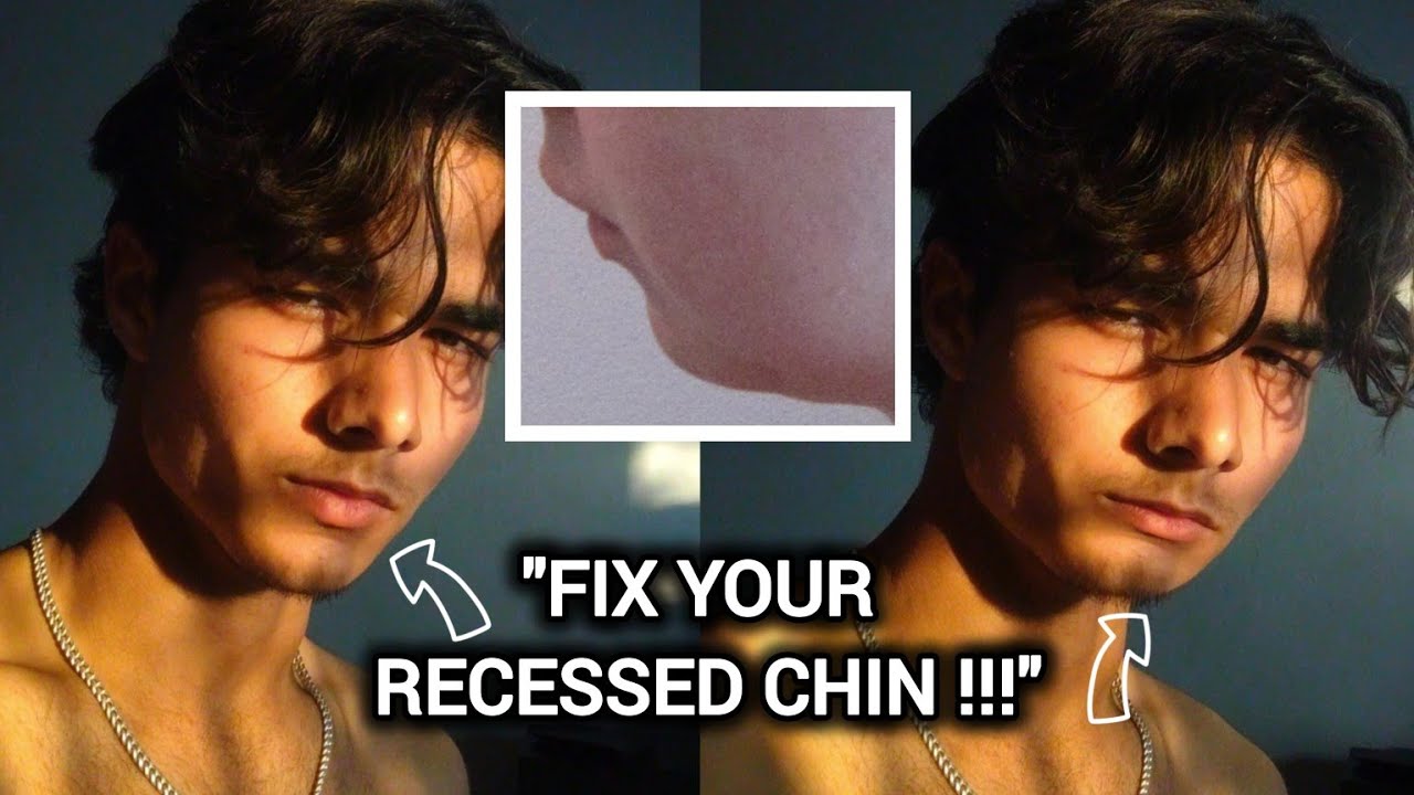 How To Fix Your Recessed Chin (Full Guide) 