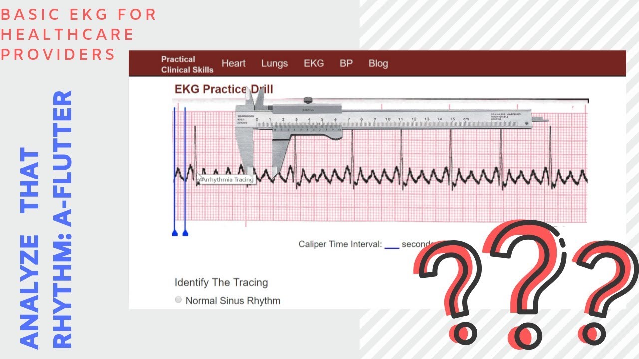 Analyze That EKG Rhythm: Atrial Flutter (A-Flutter)