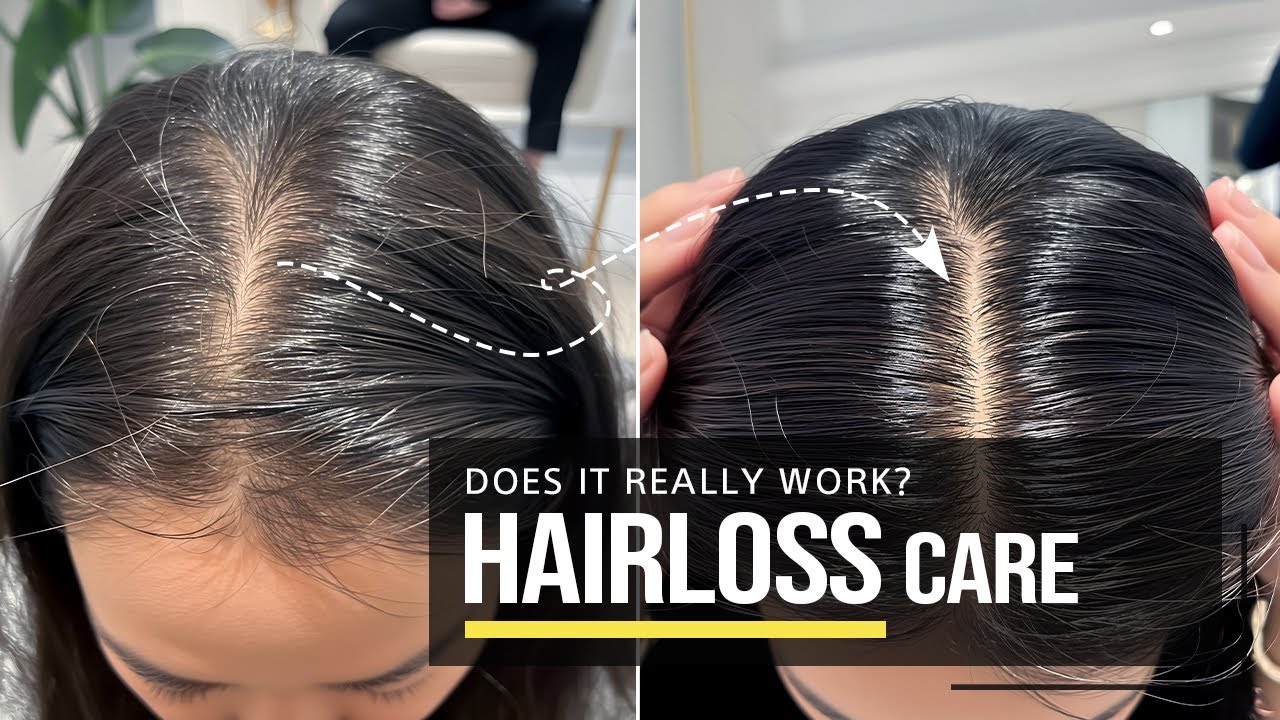 Hair Loss Products: Do They Really Work? The Best Korean Hair Loss Recommendations