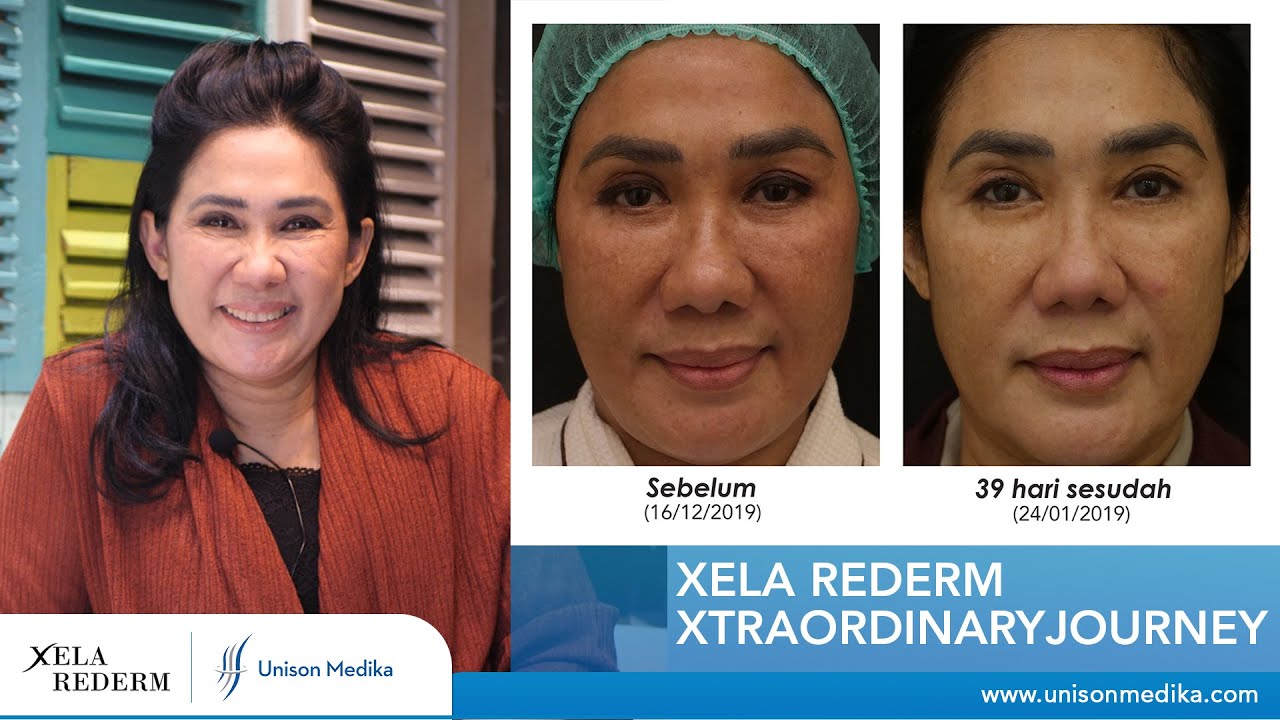 TAMPIL LEBIH PERCAYA DIRI TANPA MAKE UP SETELAH MELAKUKAN PERAWATAN XELA REDERM
