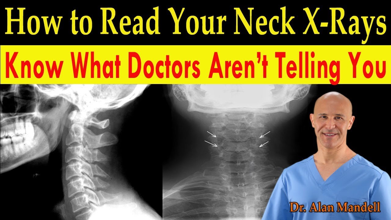 How to Read Your Neck X-rays / Know What Doctors Are Not Telling You - Dr. Alan Mandell, D.C.