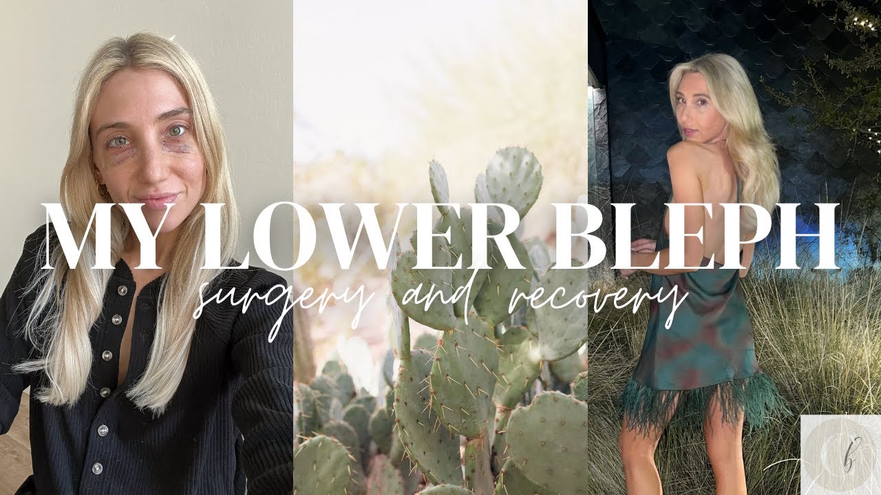 My Lower Blepharoplasty - Q&A + Before/After Pics At End