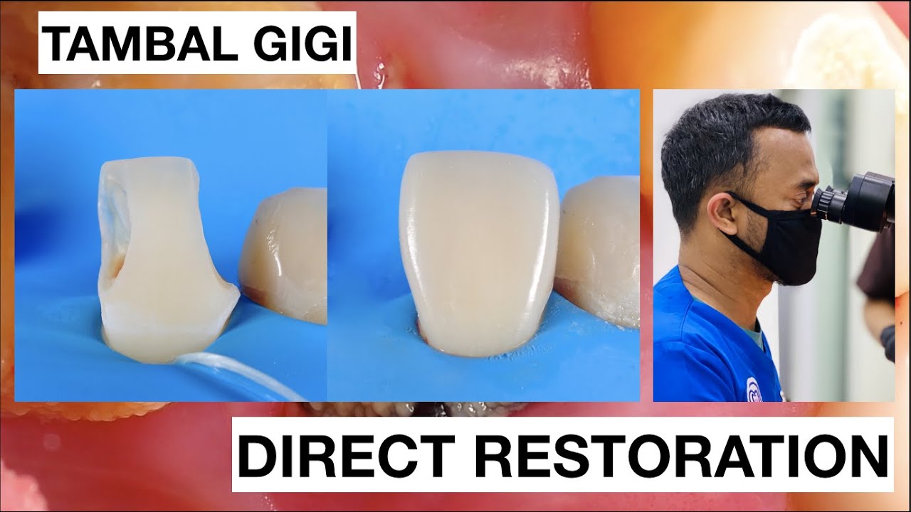 Step by Step Direct Veneer Composite Restoration | Dentist Griya RR
