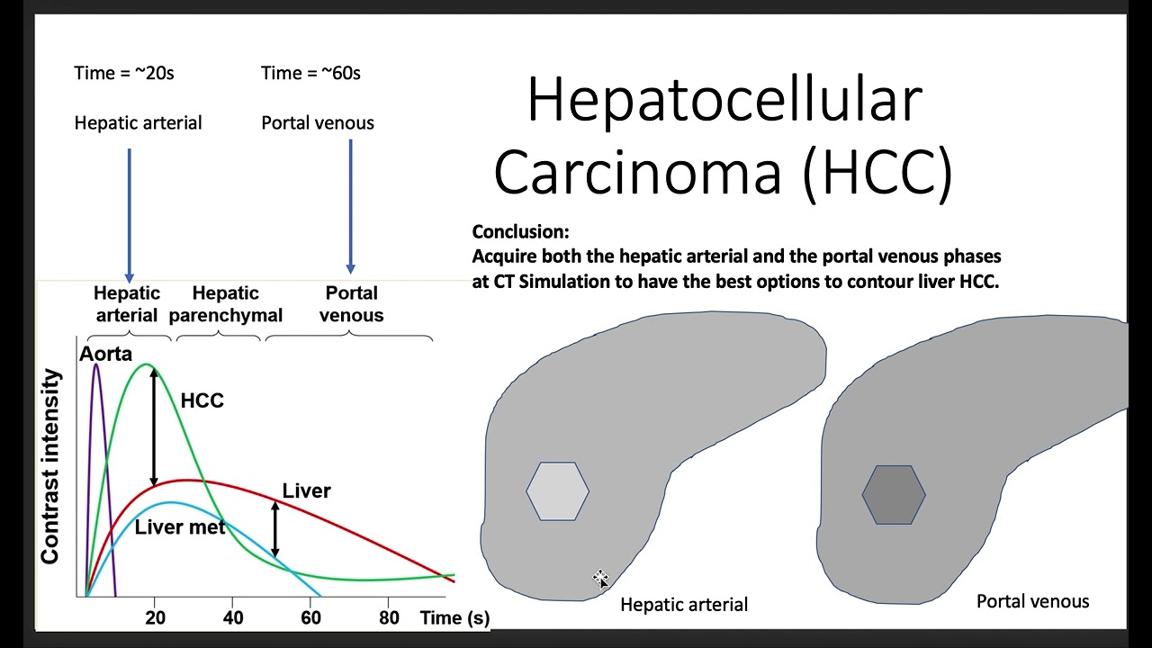 Liver SBRT IV contrast phases explained