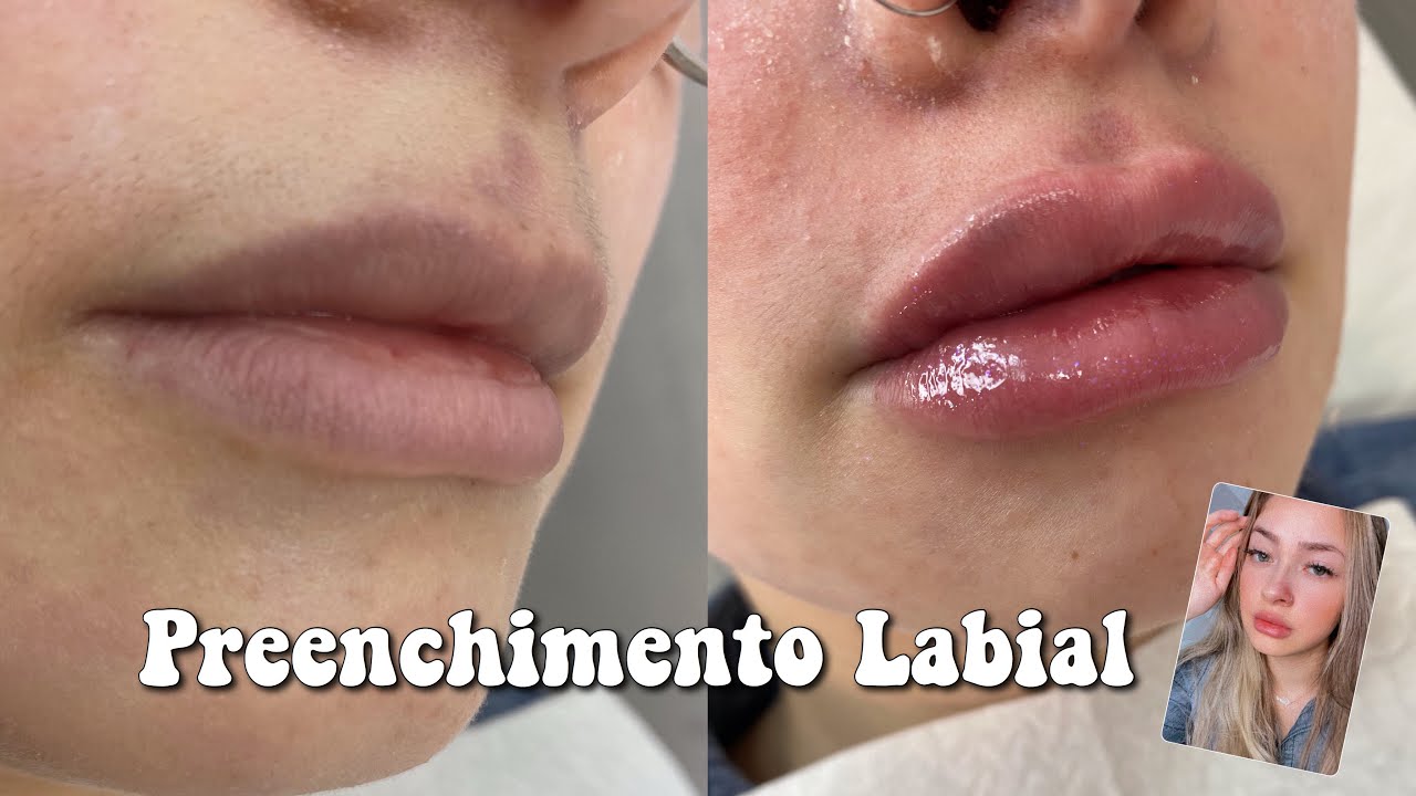 PREENCHIMENTO LABIAL (valores, dor, inchaço...)